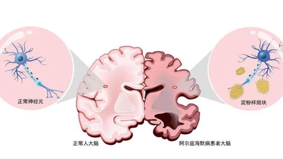 老年癡呆最新治療方法研究突破